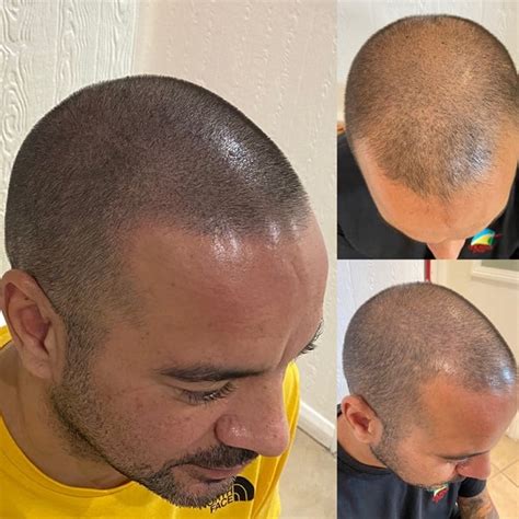 Scalp Micropigmentation London .